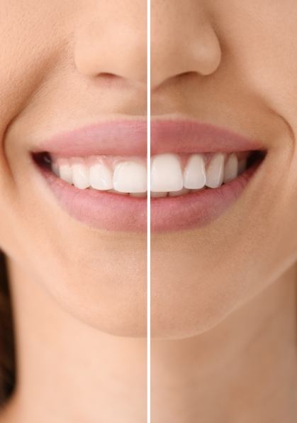 Comparison of gummy smile and even smile after gum recontouring
