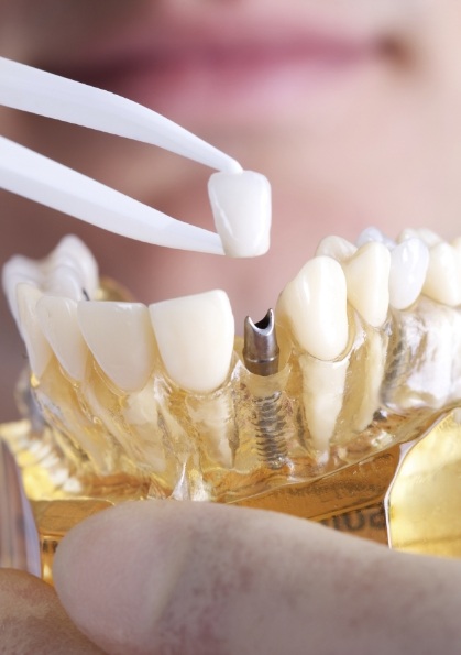 Person placing a dental crown on a dental implant in a model of the jaw
