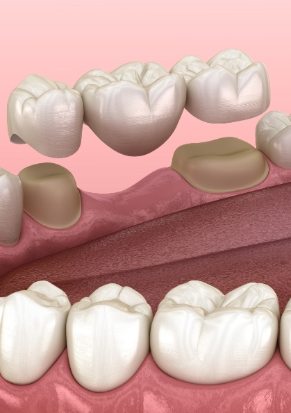 Animated dental bridge replacing a missing tooth