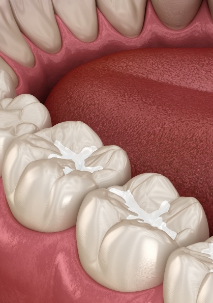 Close up of two animated teeth with tooth colored fillings