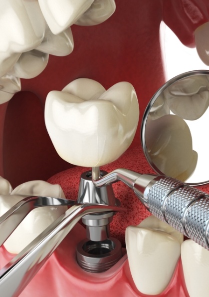 Animated dental implant with abutment and crown in the lower jaw