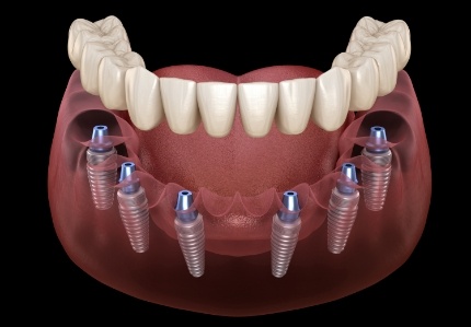 Six animated dental implants with a full implant denture