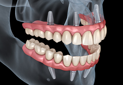 Animated x ray of person with All on 4 implant dentures on both arches