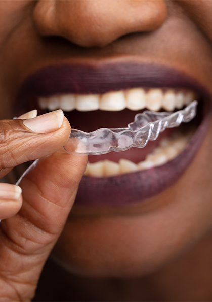 Close up of person placing clear aligner in their mouth