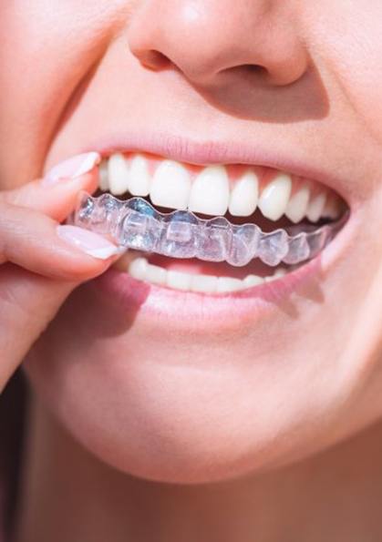 a person putting on their ClearCorrect aligners