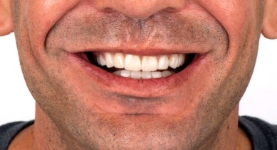 Close up of complete smile with white teeth