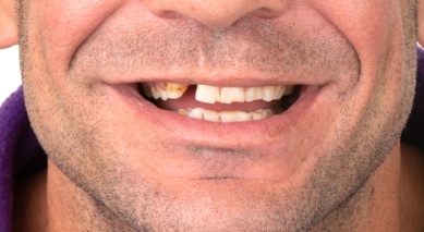 Close up of smile with missing and broken teeth