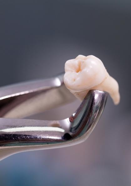 Dental forceps holding a tooth after tooth extraction in Dallas