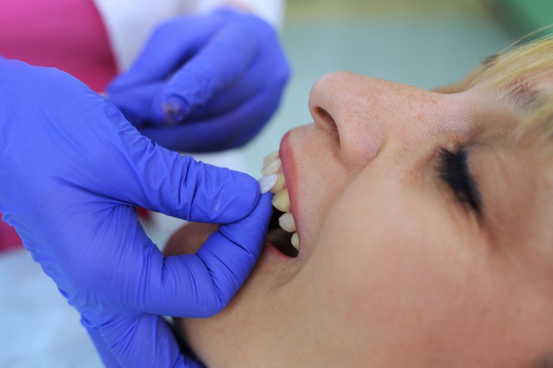 A dentist placing porcelain veneers on a woman’s teeth